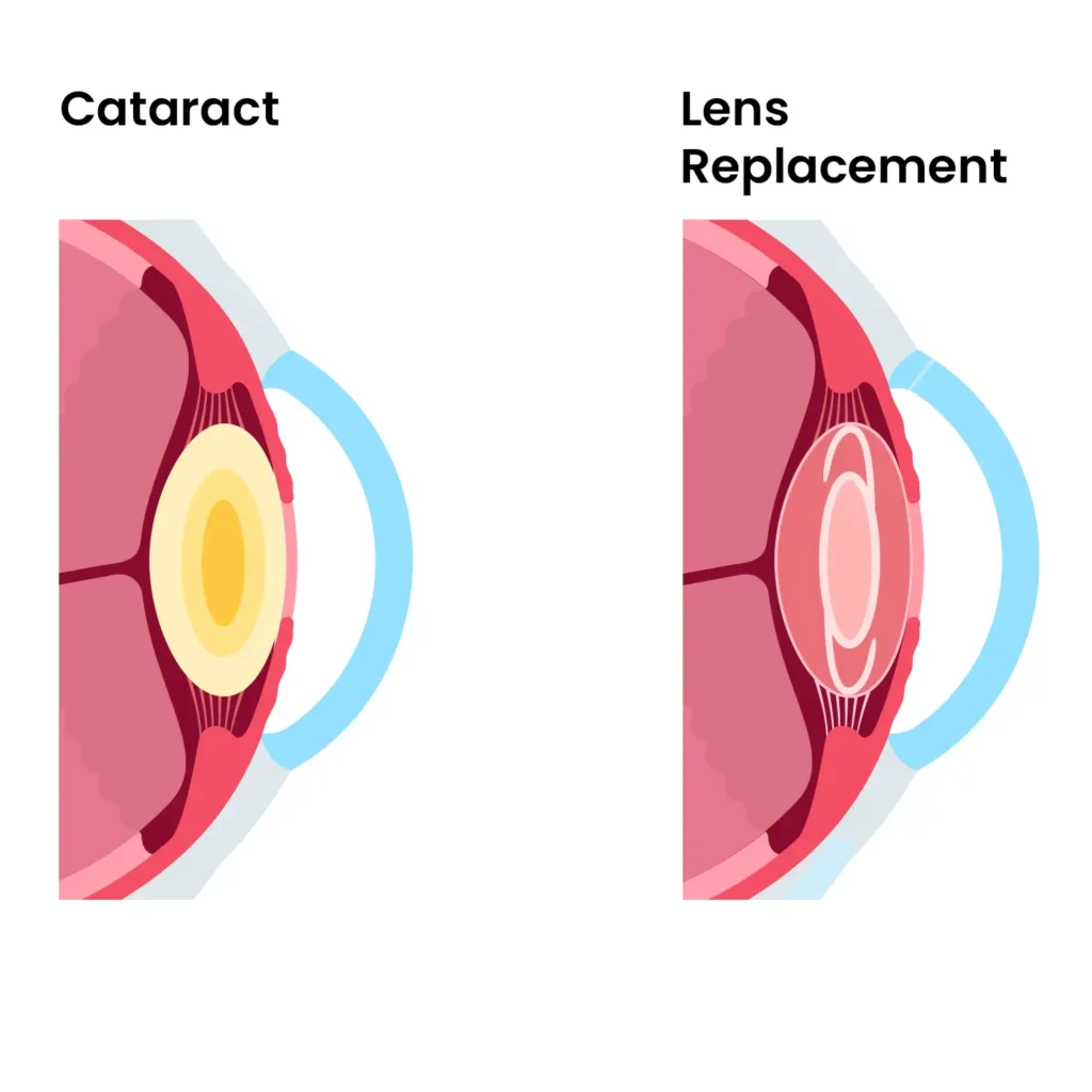 Cataract and RLE lens replacement diagram