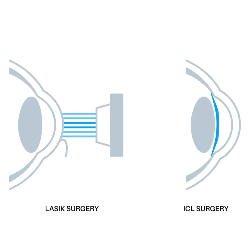 evo-icl-lasik-difference