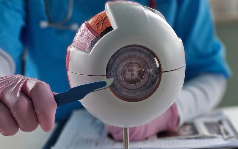 choosing a cataract surgeon