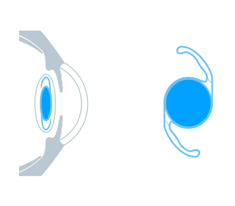 how refractive lens exchange is done how refractive lens exchange is done